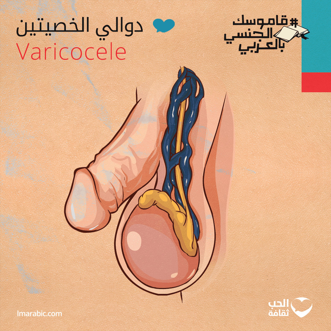 دوالي الخصية