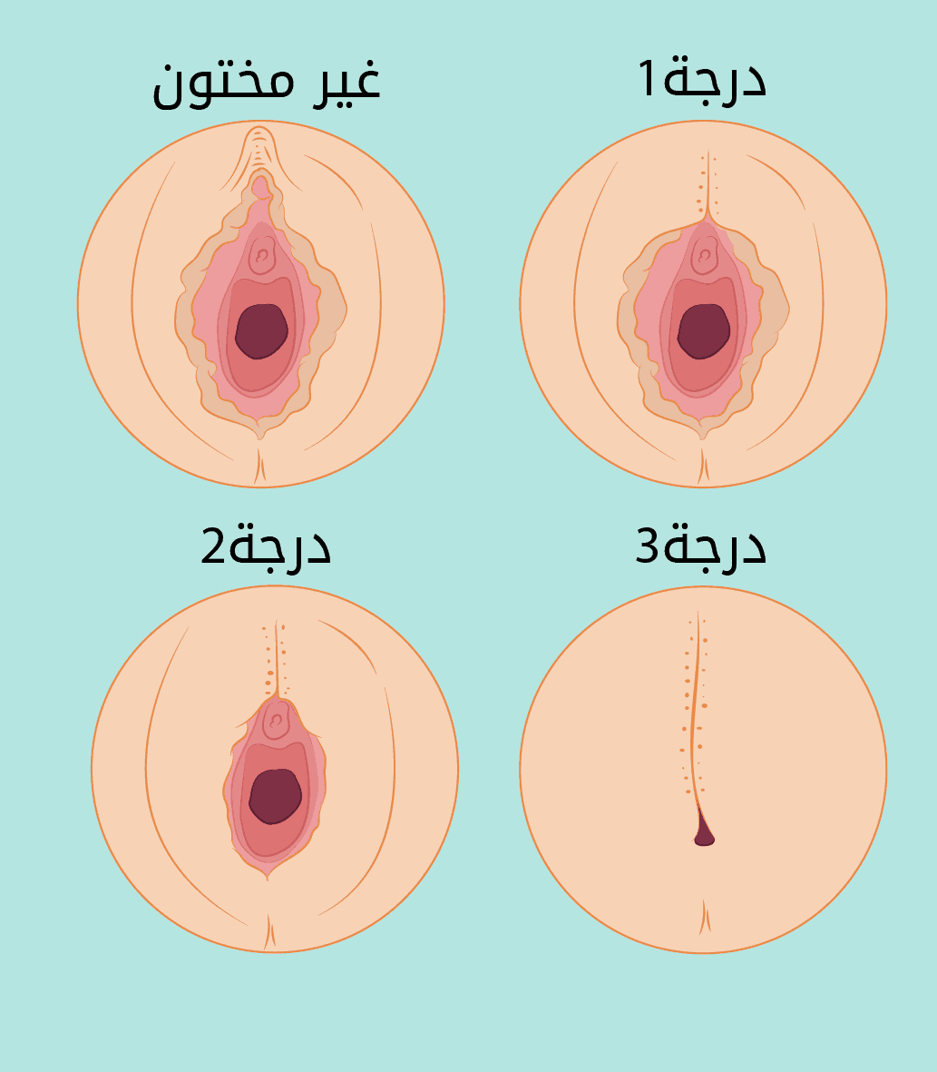 صور توضيحيه عن درجات ختان الإناث