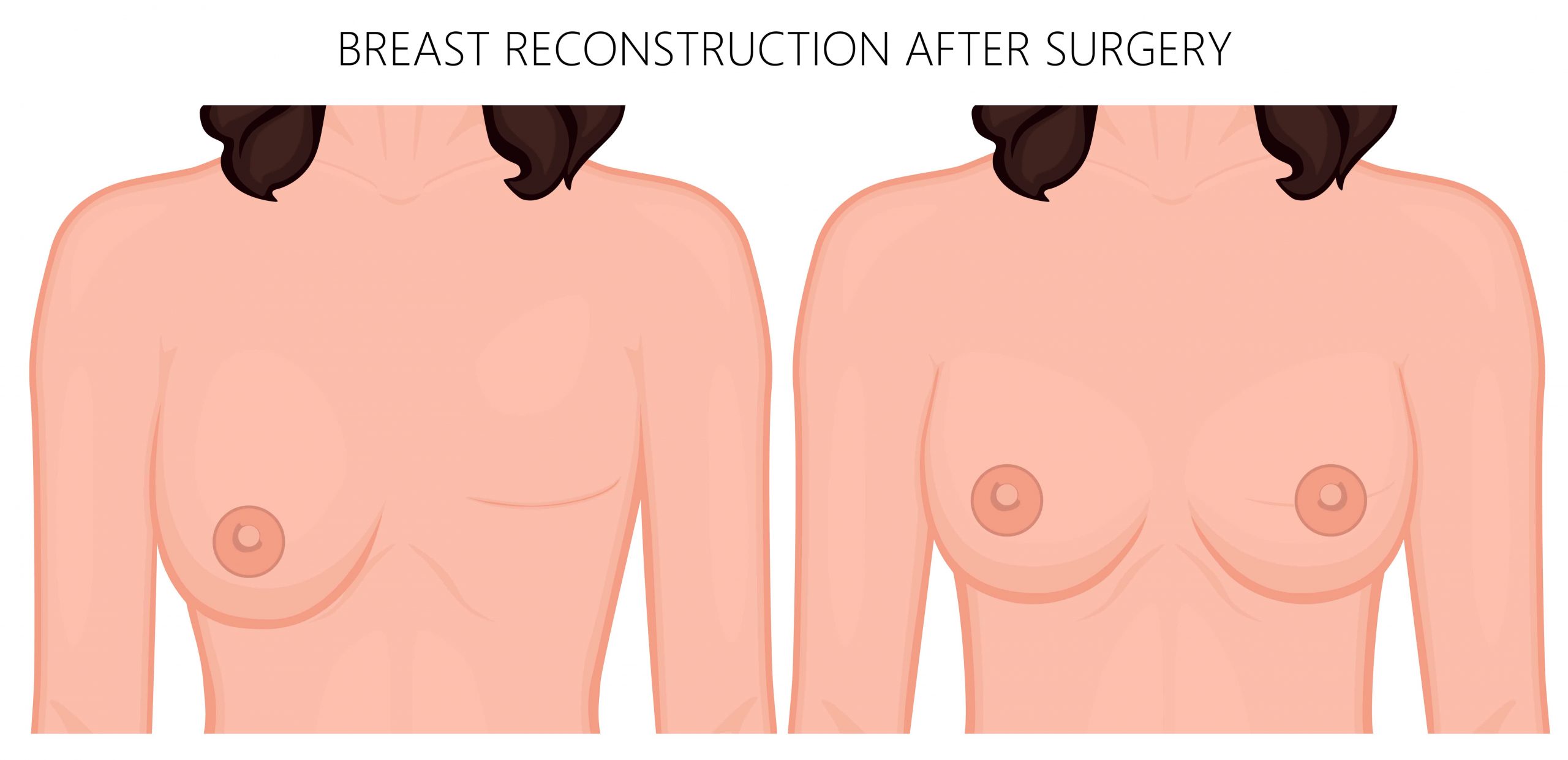 عملية إعادة بناء الثدي